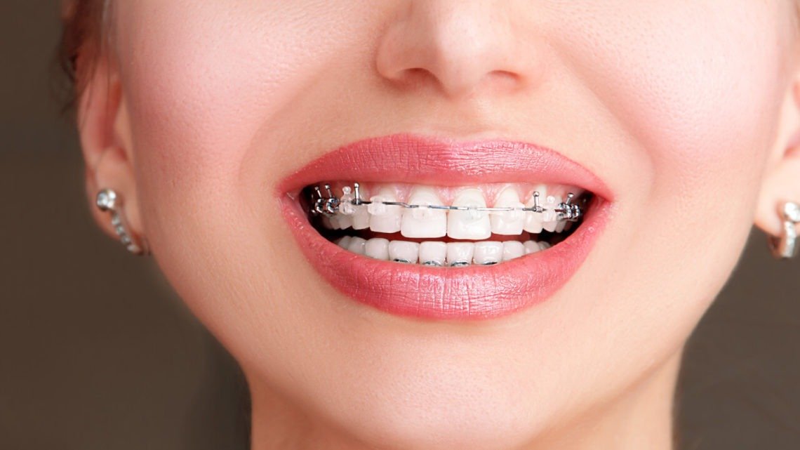 Damon Braces